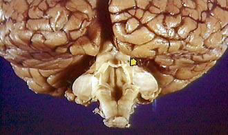 Pedúnculo Cerebelar Superior