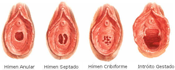 types of hymens Tipos de Himens